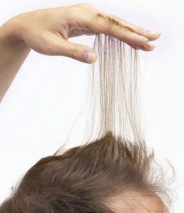 Thinning Hair Solutions Walnut Creek CA East Bay Contra Costa